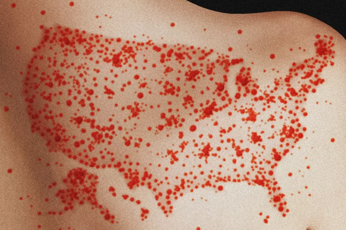 Study warns measles could become endemic in US as vaccination rates continuously fall