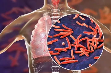 Tuberculosis makes dangerous comeback as global health efforts stall