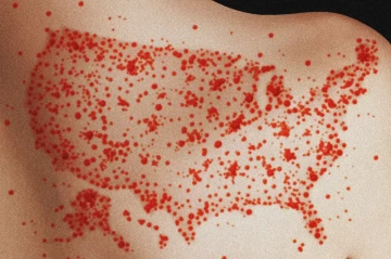Study warns measles could become endemic in US as vaccination rates continuously fall