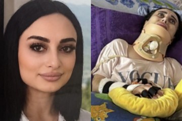 В Баку скончалась 34-летняя женщина, ставшая парализованной после ринопластики, проведенной в прошлом году
