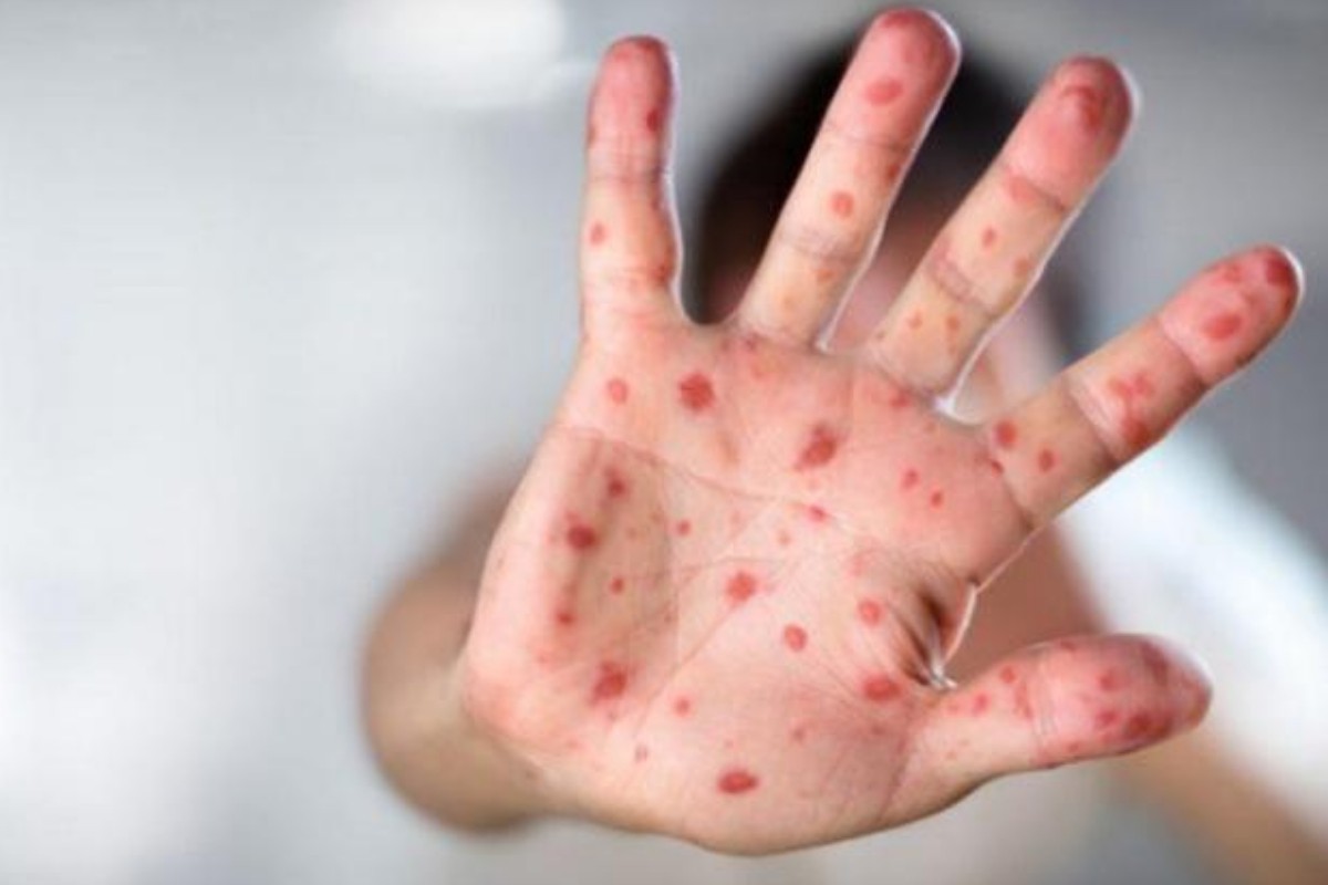 Nazirlik qızılcaya yoluxma ilə bağlı epidemioloji vəziyyəti AÇIQLADI