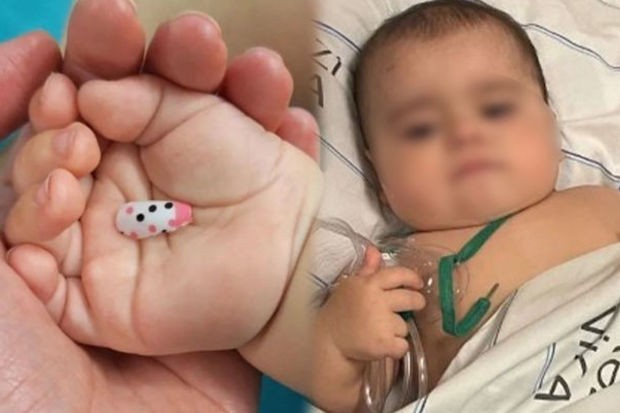 6-месячный ребенок проглотил пластиковый ноготь - ФОТО