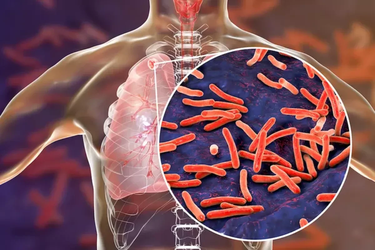 Tuberculosis makes dangerous comeback as global health efforts stall
