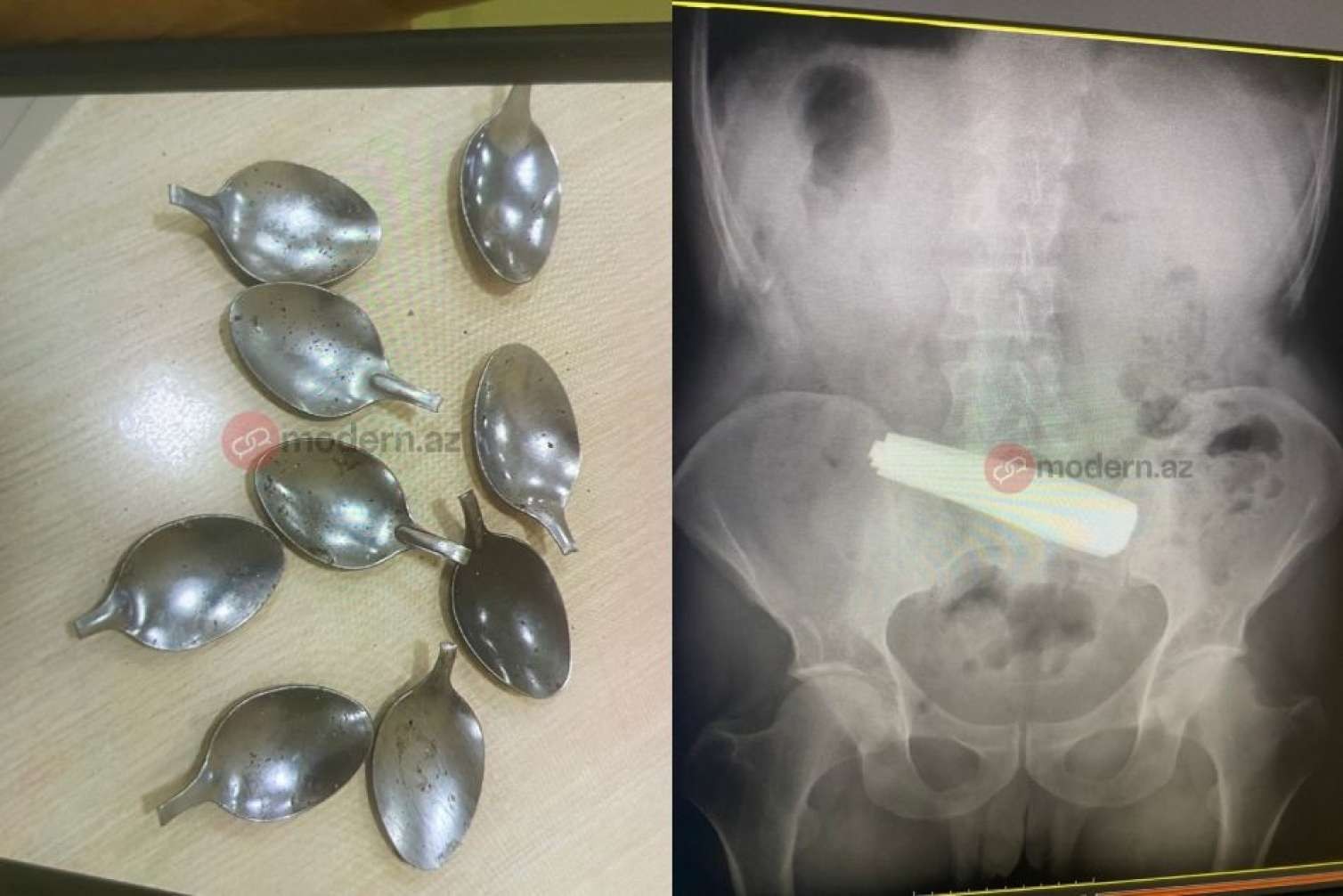 Bakıda sakini 9 qaşıq uddu - Reanimasiyadadır - FOTO