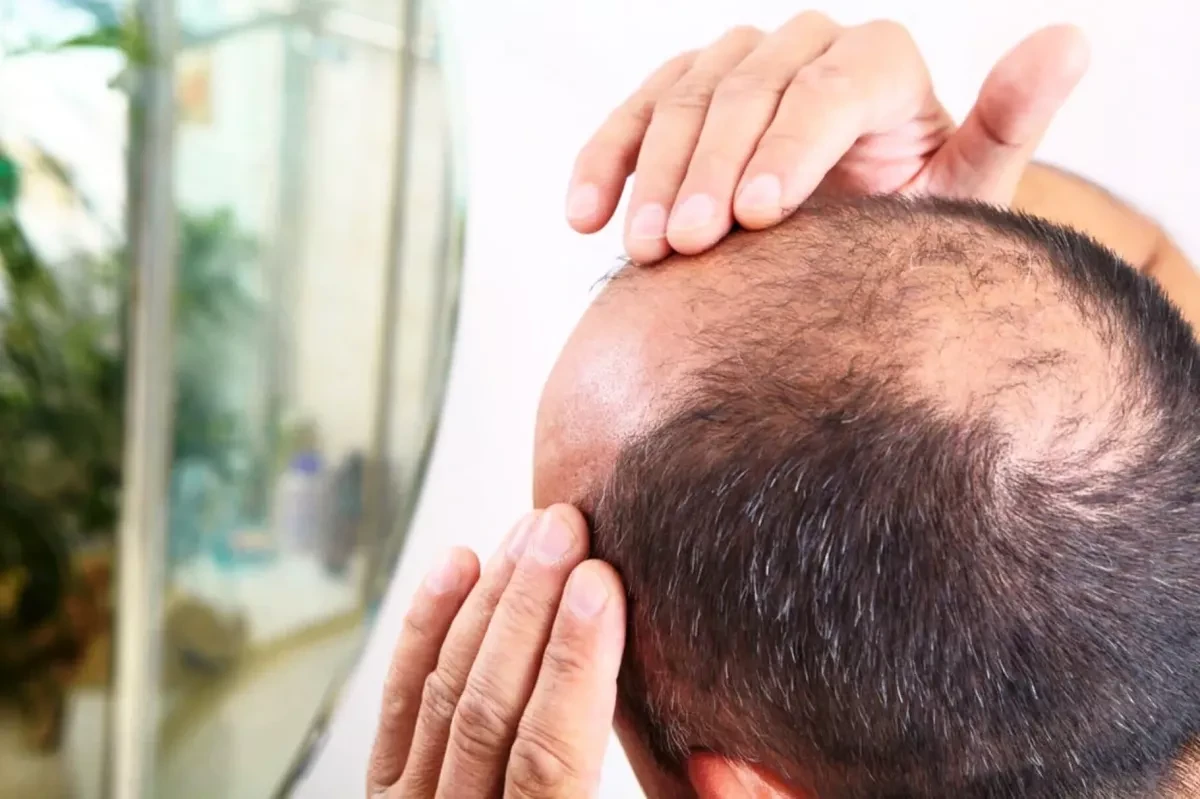 Israeli study warns of popular hair-loss drug's links to increased suicides