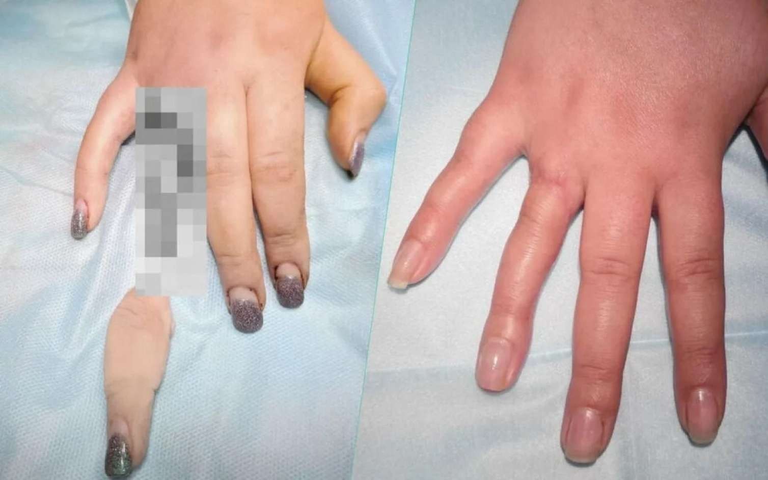 Qadın nişan üzüyünə görə barmağını qopardı