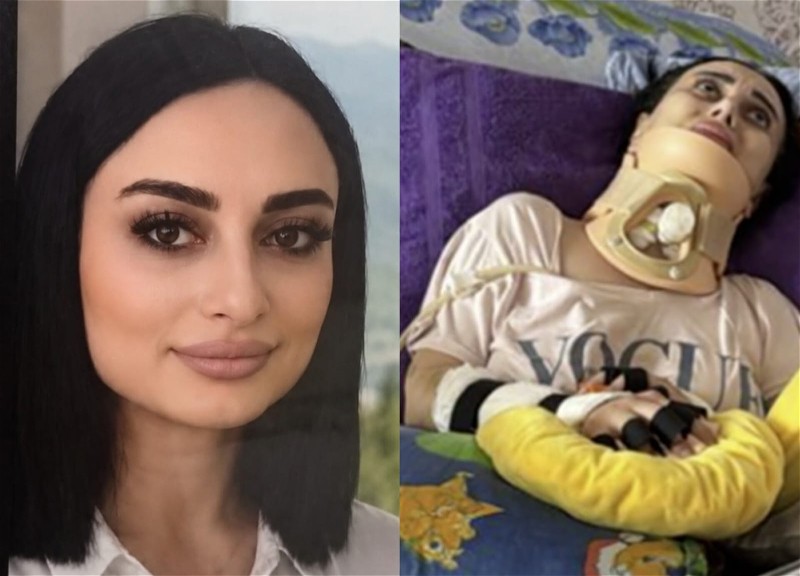 В Баку скончалась 34-летняя женщина, ставшая парализованной после ринопластики, проведенной в прошлом году