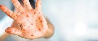 Azerbaijan confirms first case of monkeypox -JOINT STATEMENT