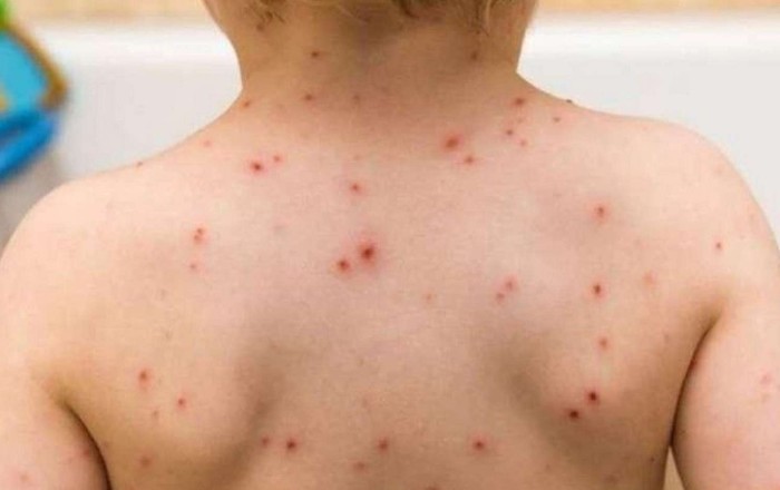 Azərbaycanda qızılca epidemyası ilə bağlı rəsmi  AÇIQLAMA