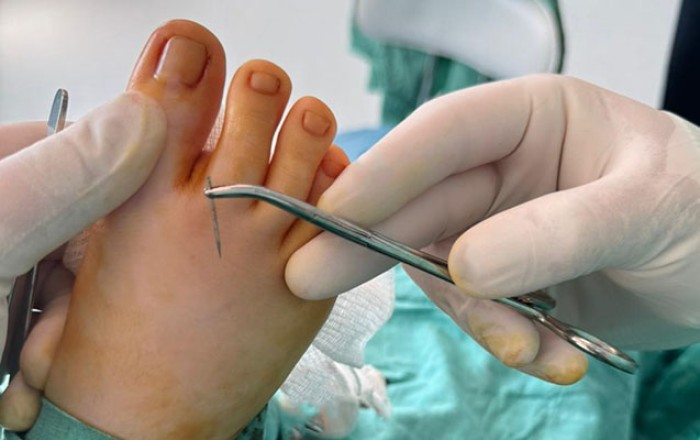 Ayağında qırılıb qalan iynə 14 gün sonra aşkarlandı -
