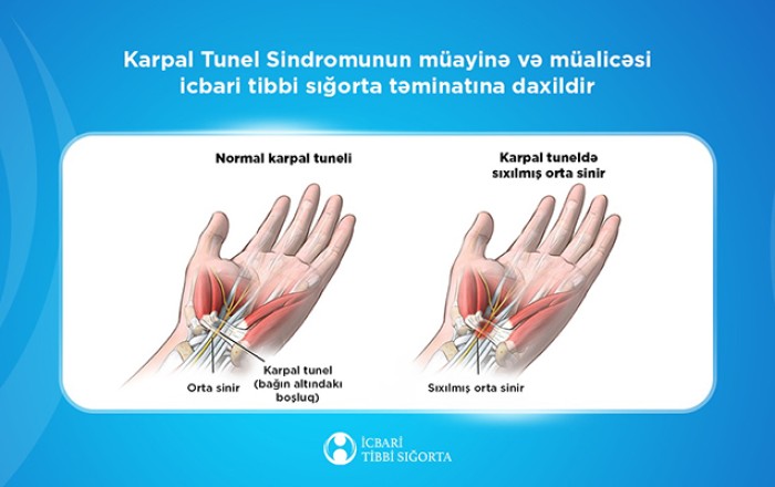 Bu sindromun müalicəsi də icbari tibbi sığorta təminatına daxildir