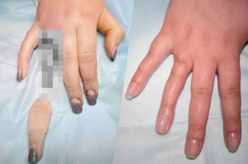 Qadın nişan üzüyünə görə barmağını qopardı