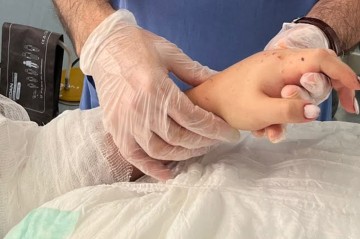 Bakıda qızın qopmuş qolu yerinə bərpa olundu -