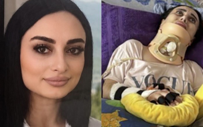 В Баку скончалась 34-летняя женщина, ставшая парализованной после ринопластики, проведенной в прошлом году