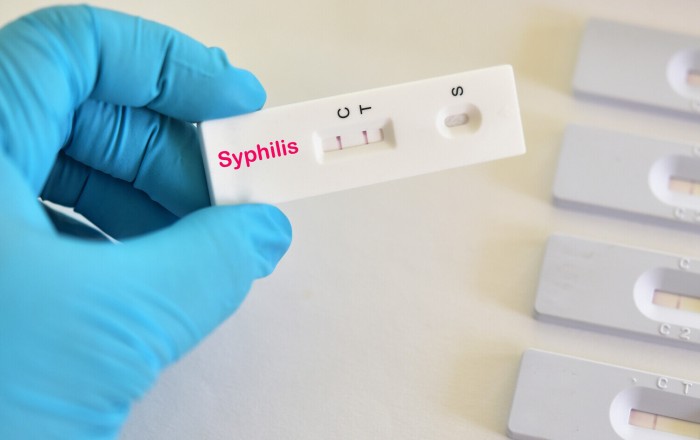 Avropada cinsi yolla keçən infeksiyaların sayı KƏSKİN ARTDI