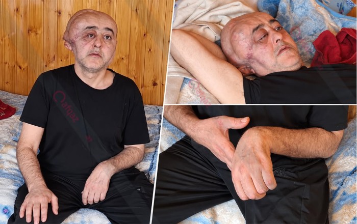 “5 ildir yataq xəstəsidir, pensiya ala bilmir” - Video
