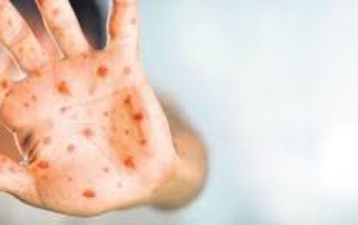 Azerbaijan confirms first case of monkeypox -JOINT STATEMENT